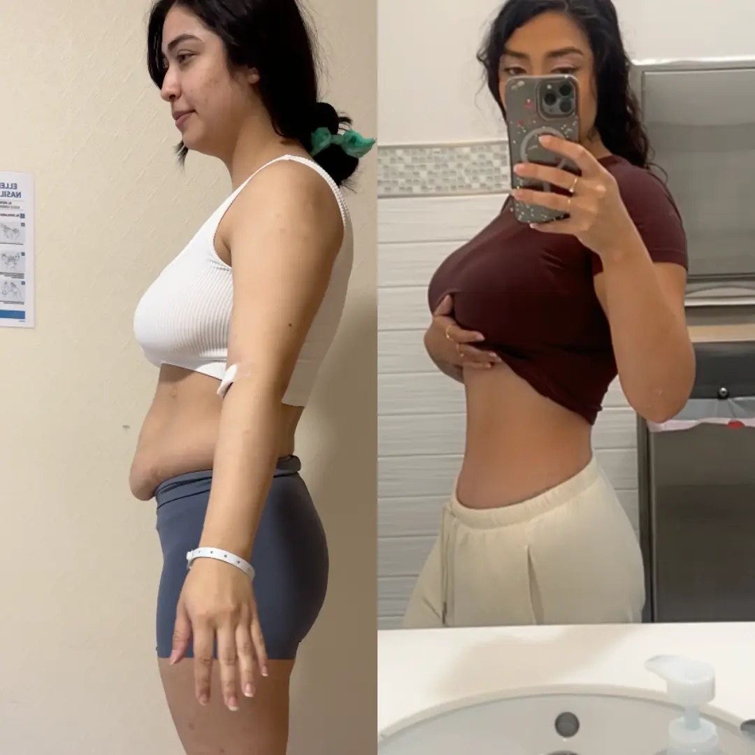TUMMY TUCK